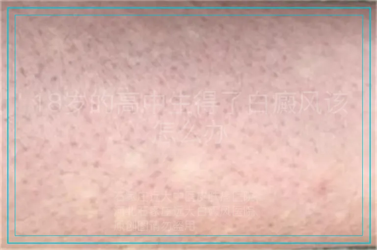 18岁的高中生得了白癜风该怎么办