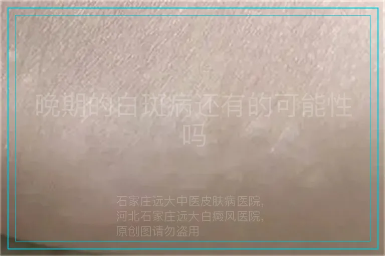 晚期的白斑病还有的可能性吗