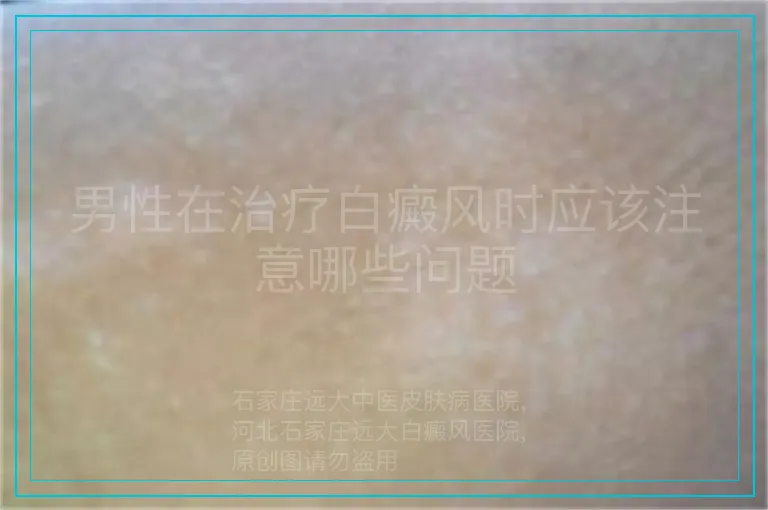 男性在治疗白癜风时应该注意哪些问题