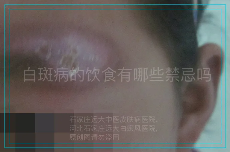 白斑病的饮食有哪些禁忌吗
