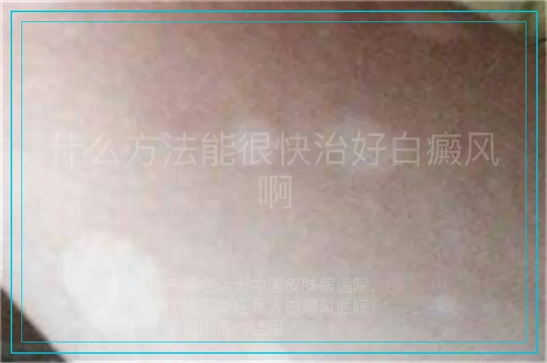 什么方法能很快治好白癜风啊