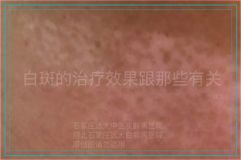白斑的治疗效果跟那些有关