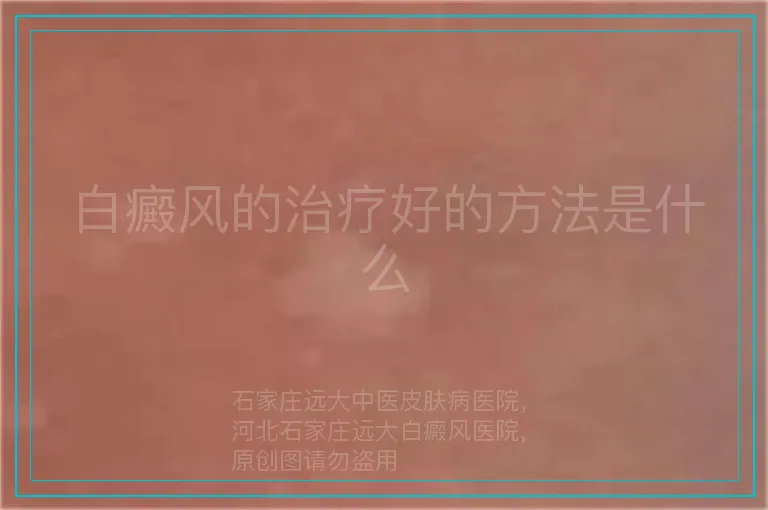 白癜风的治疗好的方法是什么