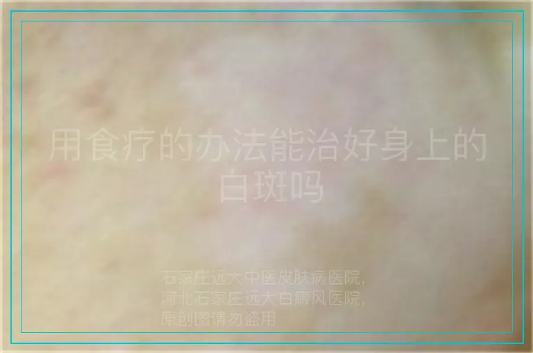 用食疗的办法能治好身上的白斑吗