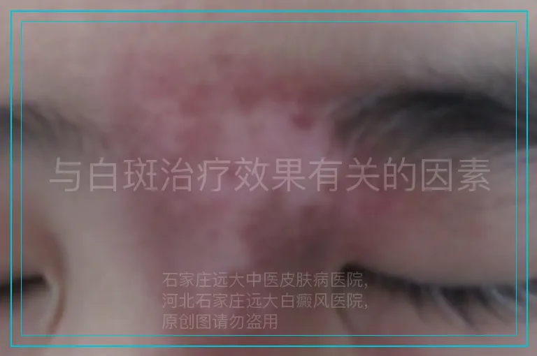 与白斑治疗效果有关的因素