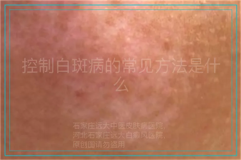 控制白斑病的常见方法是什么