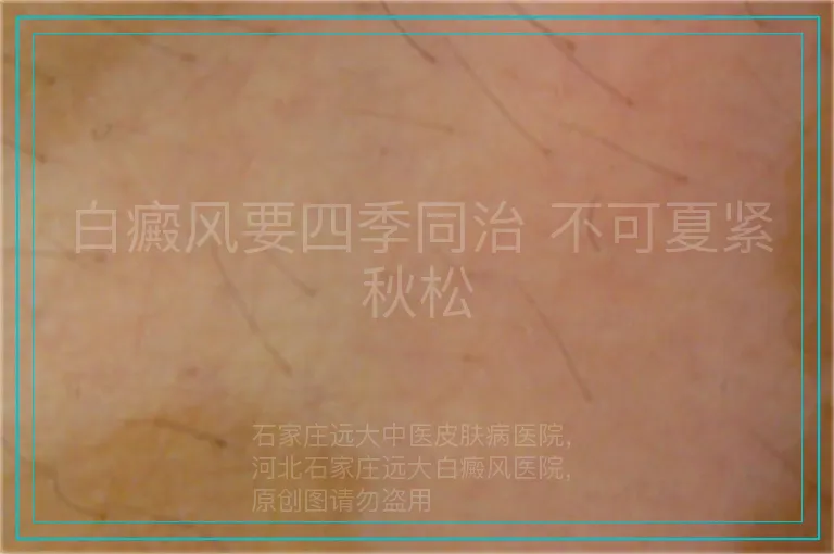 白癜风要四季同治 不可夏紧秋松