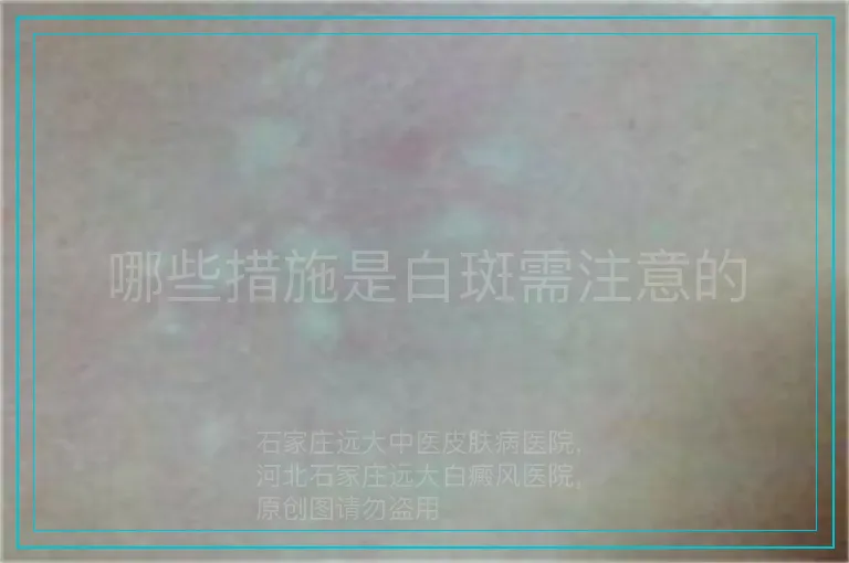 哪些措施是白斑需注意的