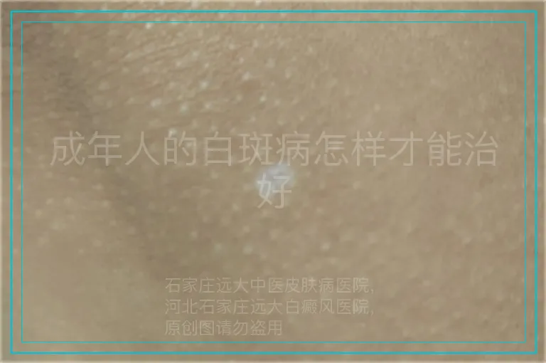 成年人的白斑病怎样才能治好