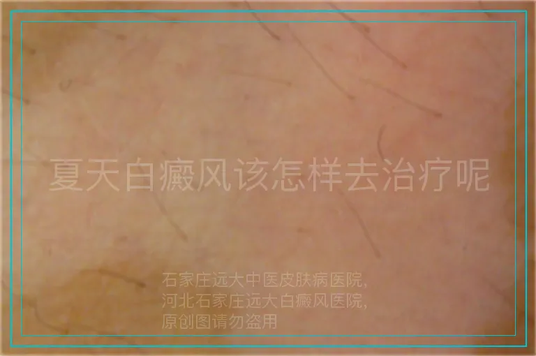 夏天白癜风该怎样去治疗呢