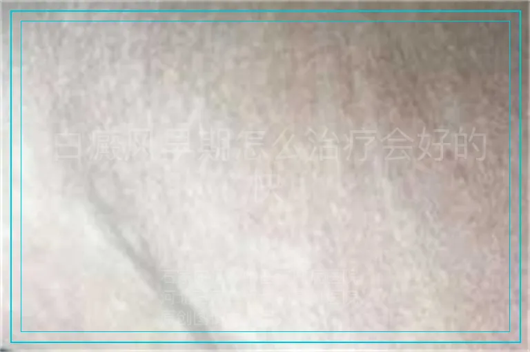白癜风早期怎么治疗会好的快