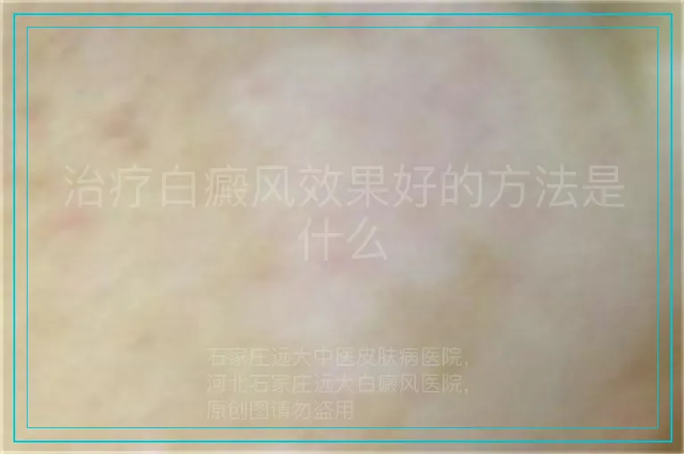 治疗白癜风效果好的方法是什么