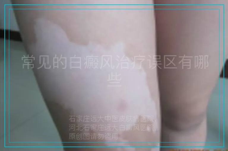 常见的白癜风治疗误区有哪些