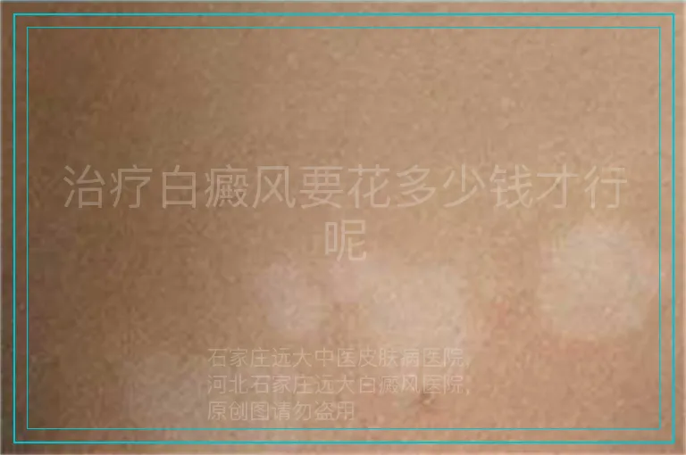 治疗白癜风要花多少钱才行呢
