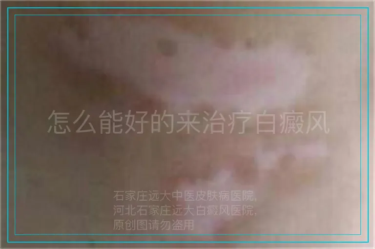 怎么能好的来治疗白癜风