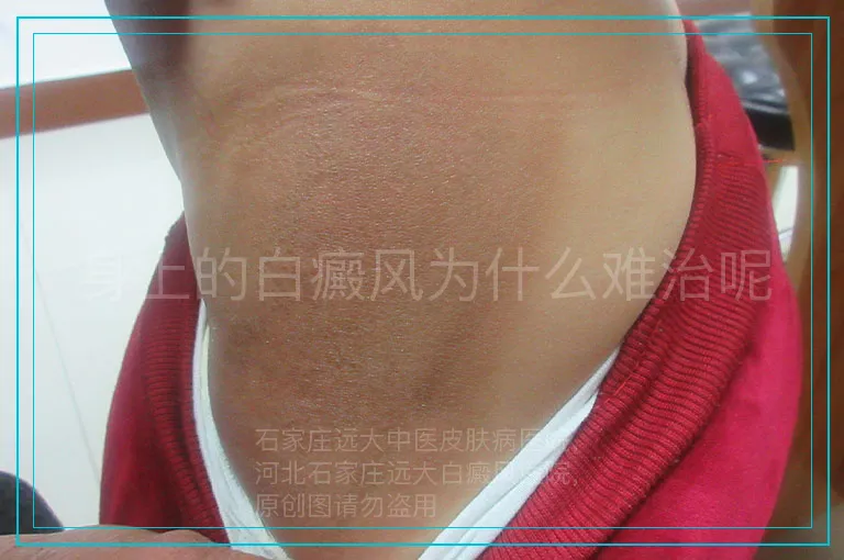 身上的白癜风为什么难治呢