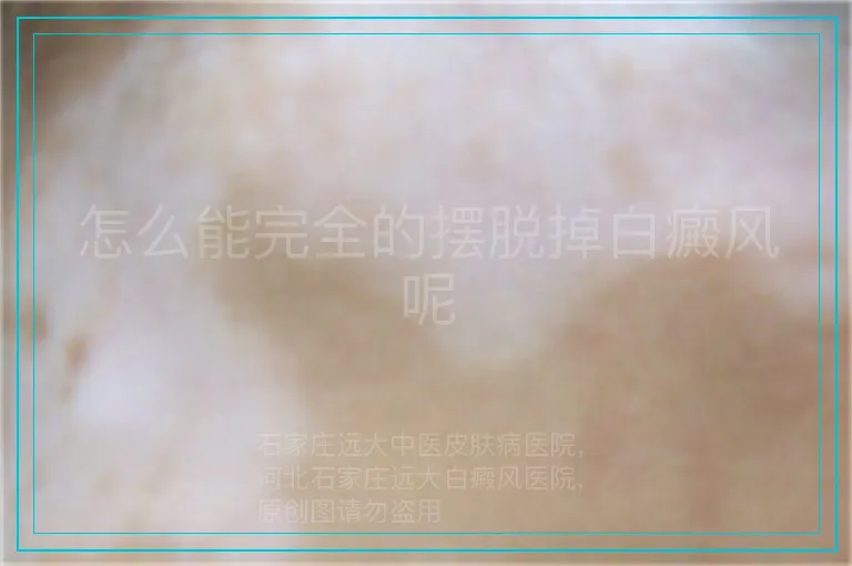 怎么能完全的摆脱掉白癜风呢
