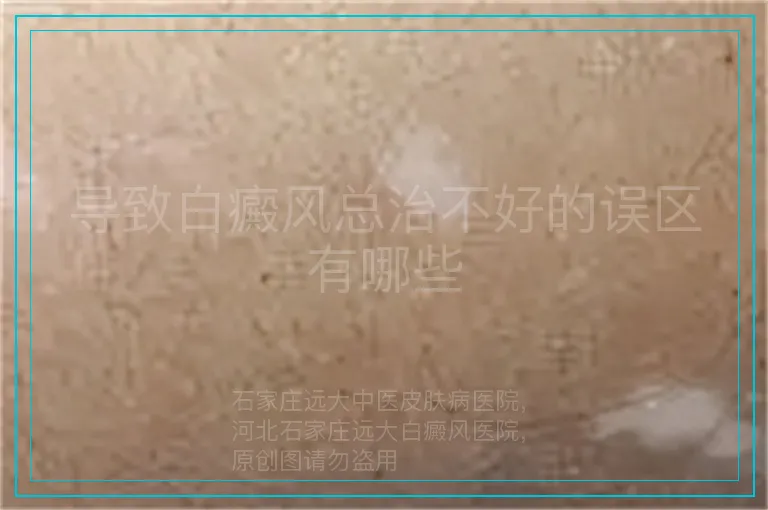 导致白癜风总治不好的误区有哪些