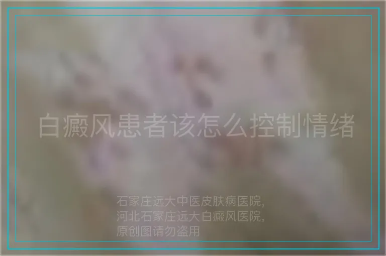白癜风患者该怎么控制情绪