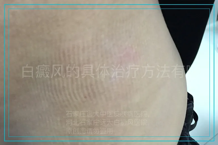 白癜风的具体治疗方法有哪