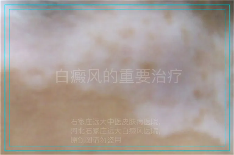 白癜风的重要治疗