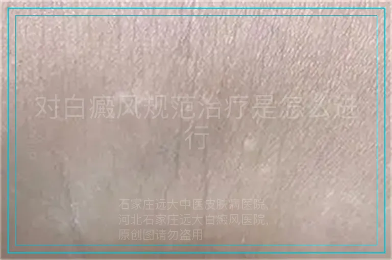 对白癜风规范治疗是怎么进行
