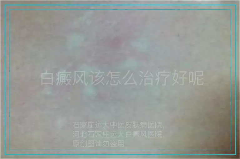 白癜风该怎么治疗好呢