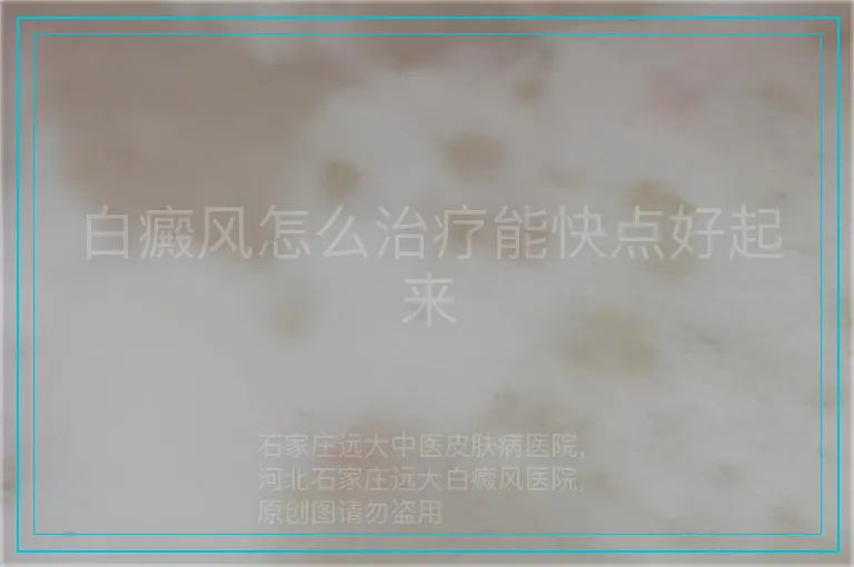 白癜风怎么治疗能快点好起来