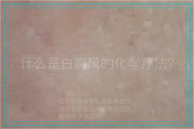 什么是白癜风的化学疗法?