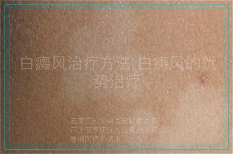 白癜风治疗方法 白癜风的优势治疗