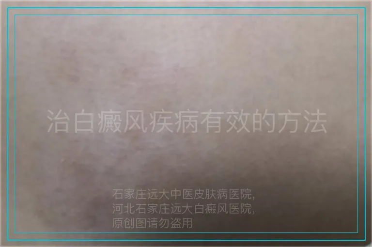 治白癜风疾病有效的方法