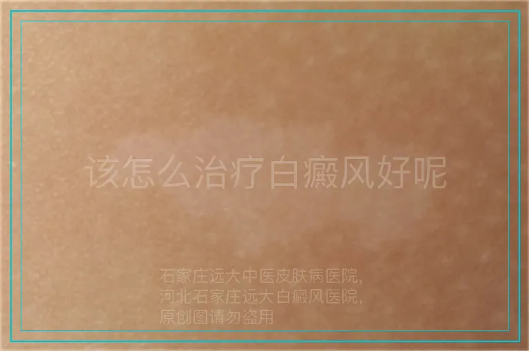 该怎么治疗白癜风好呢