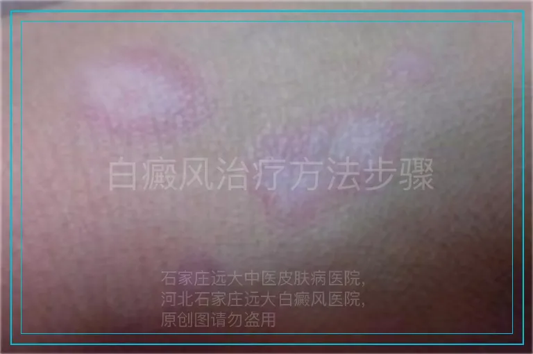 白癜风治疗方法步骤