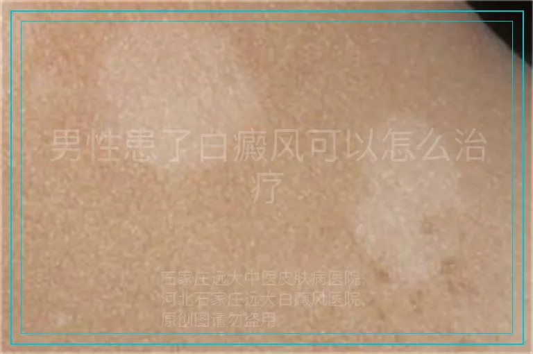 男性患了白癜风可以怎么治疗