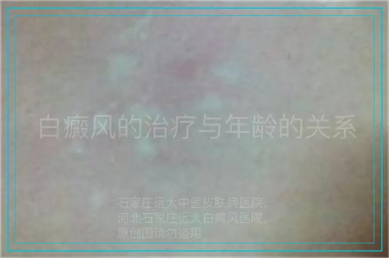 白癜风的治疗与年龄的关系