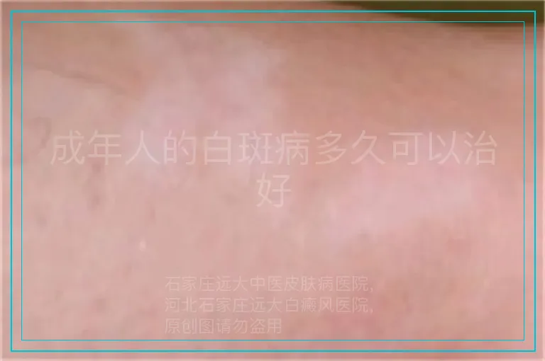 成年人的白斑病多久可以治好