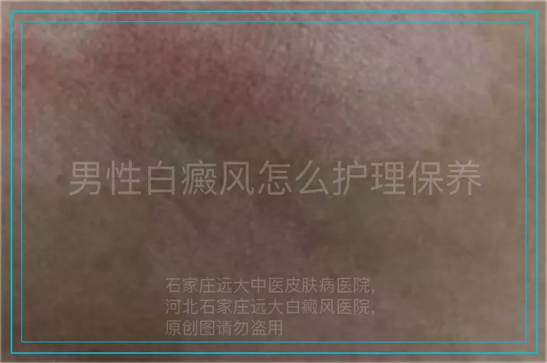 男性白癜风怎么护理保养