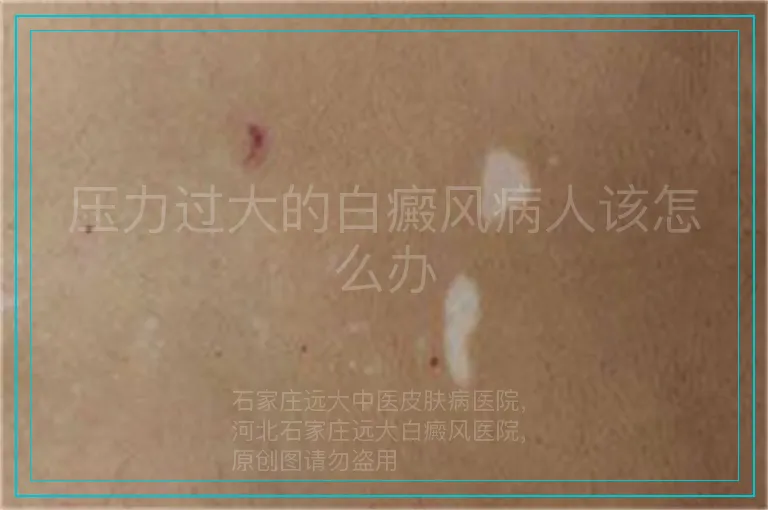 压力过大的白癜风病人该怎么办