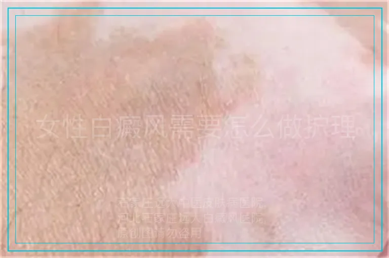 女性白癜风需要怎么做护理