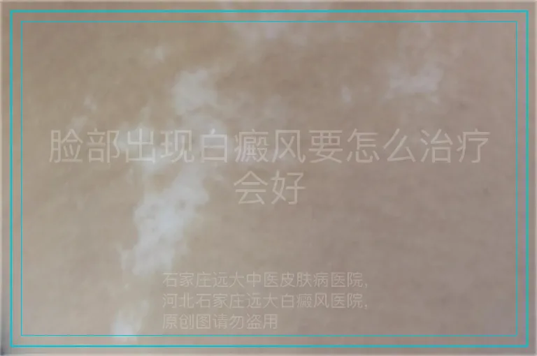 脸部出现白癜风要怎么治疗会好