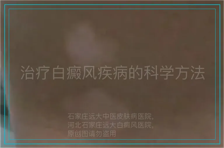 治疗白癜风疾病的科学方法