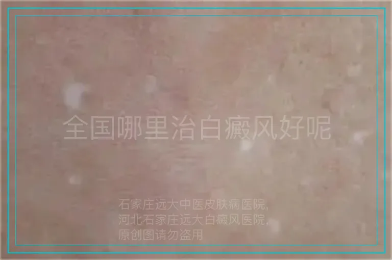 全国哪里治白癜风好呢