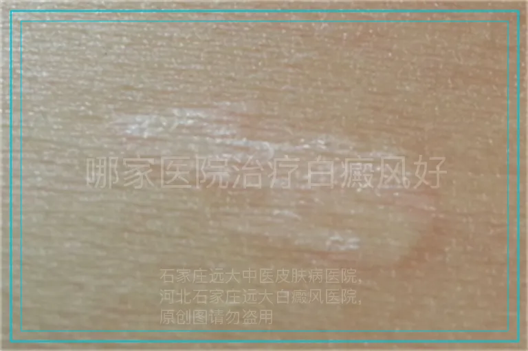 哪家医院治疗白癜风好