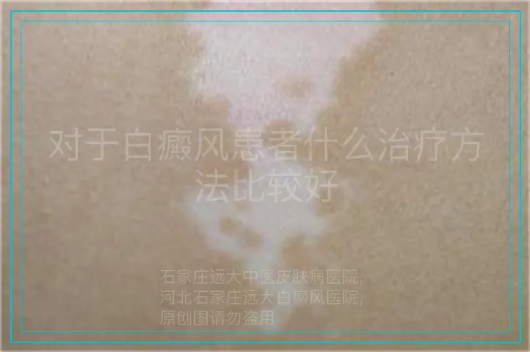 对于白癜风患者什么治疗方法比较好