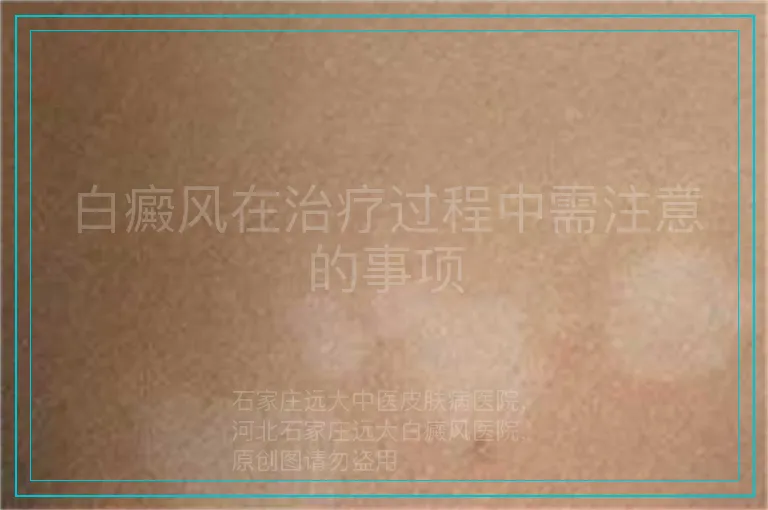 白癜风在治疗过程中需注意的事项