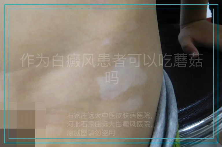 作为白癜风患者可以吃蘑菇吗