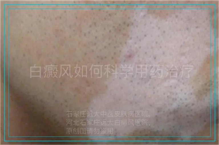 白癜风如何科学用药治疗