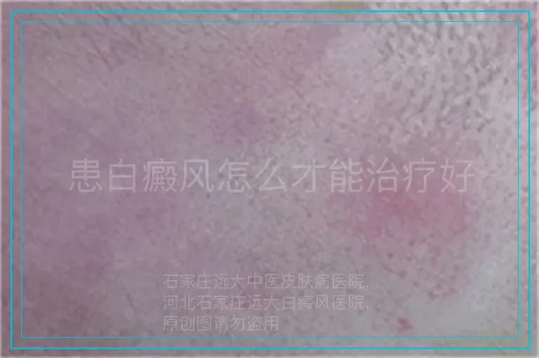 患白癜风怎么才能治疗好