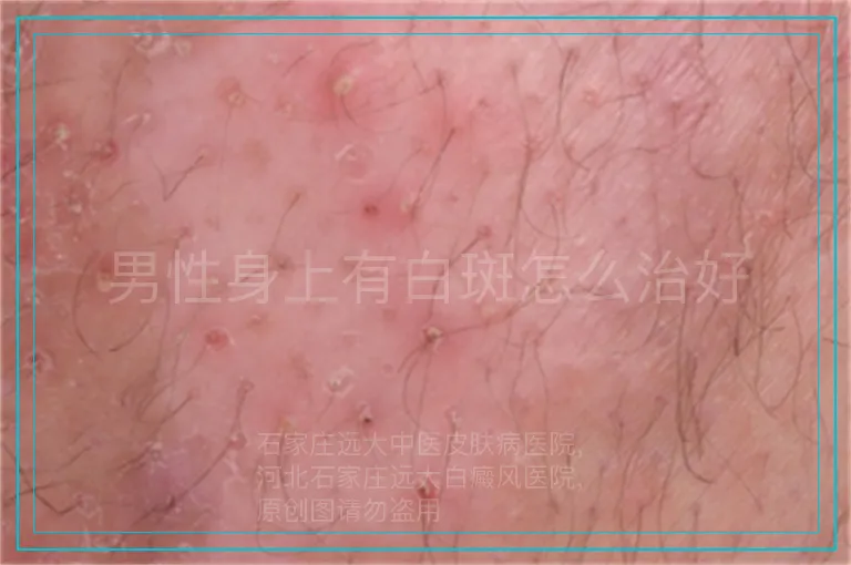 男性身上有白斑怎么治好