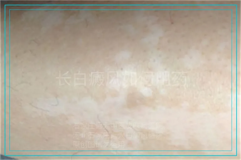 长白癜风如何用药